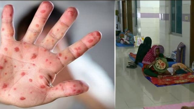 হামের চিকিৎসায় অ্যান্টিবায়োটিক কার্যকর নয়, বলছেন চিকিৎসক