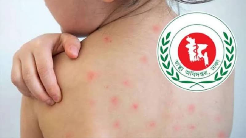হাম উপসর্গে আরও চারজনের মৃত্যু, আক্রান্ত ১৩৩২ হাম উপসর্গে আরও চারজনের মৃত্যু, আক্রান্ত ১৩৩২