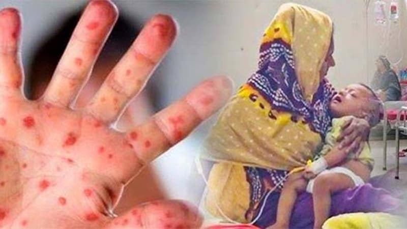 সাত মাসেও ‘নিয়ন্ত্রণহীন’ হাম সাত মাসেও ‘নিয়ন্ত্রণহীন’ হাম